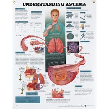 Understanding Asthma Laminated Chart
