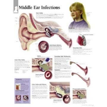 Anatomical Chart 22" x 28"  - Understanding Middle Ear Conditions