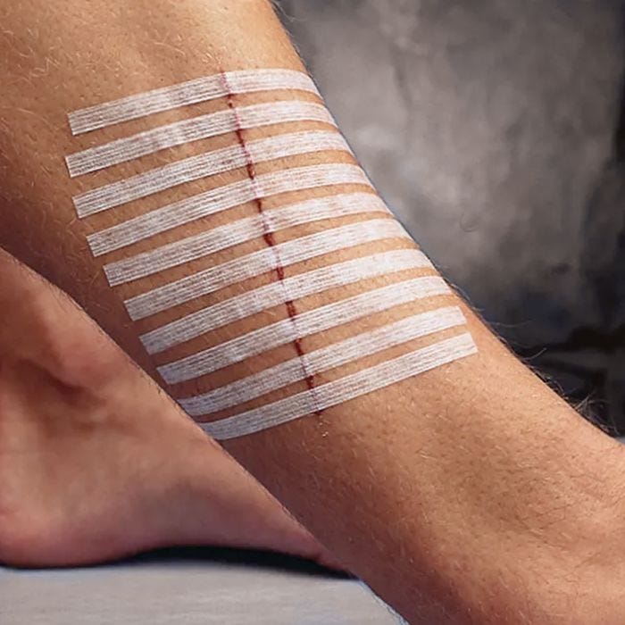 ten 3m steri-strips placed over an ankle wound
